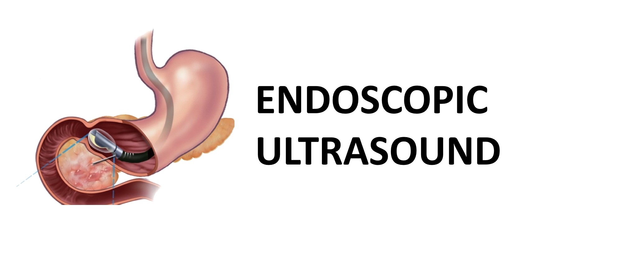 Endoscopic Ultrasound | Upper GI Endoscopy | Ahmedabad | Dr. Bhavesh ...