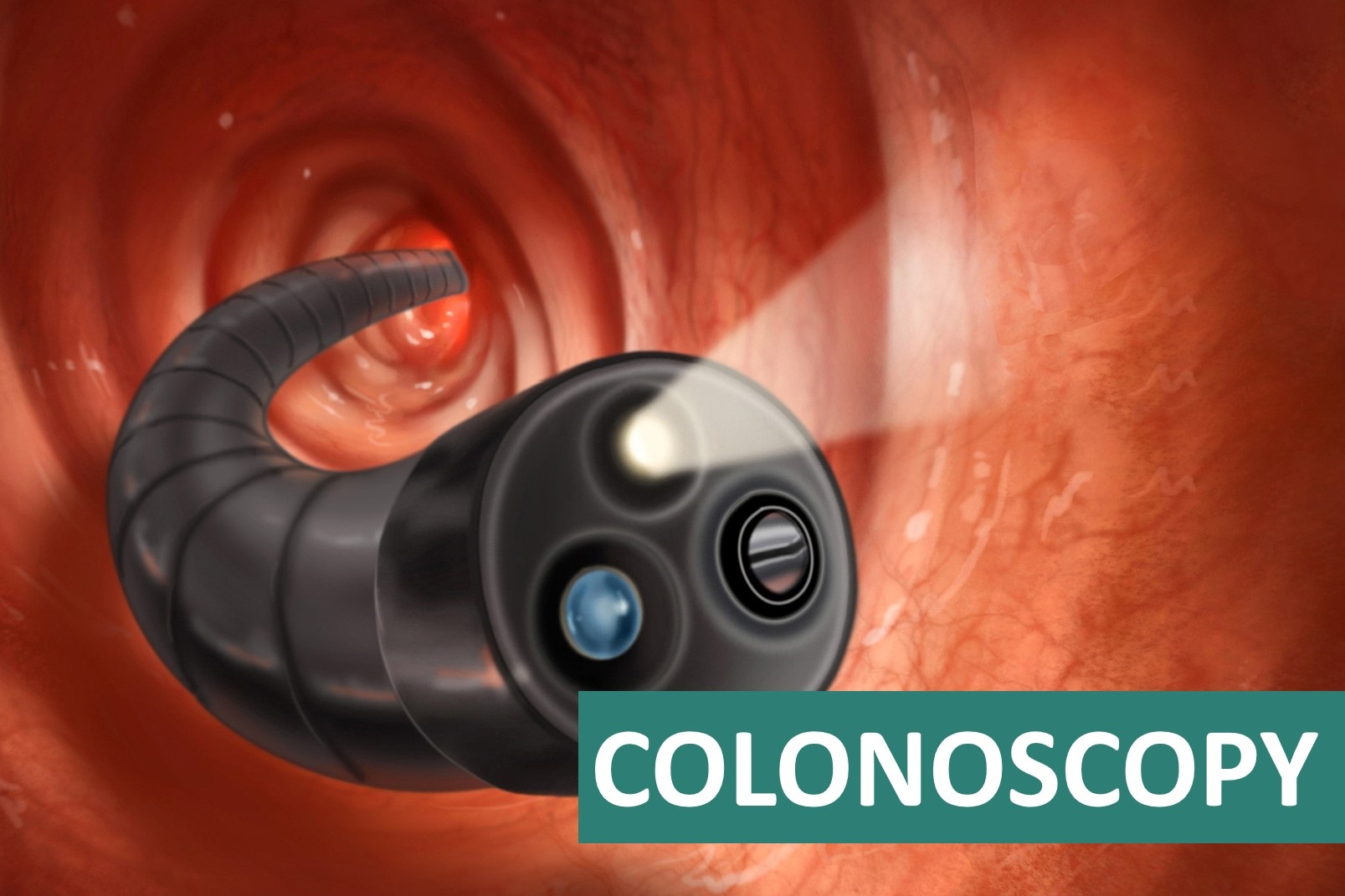 COLONOSCOPY