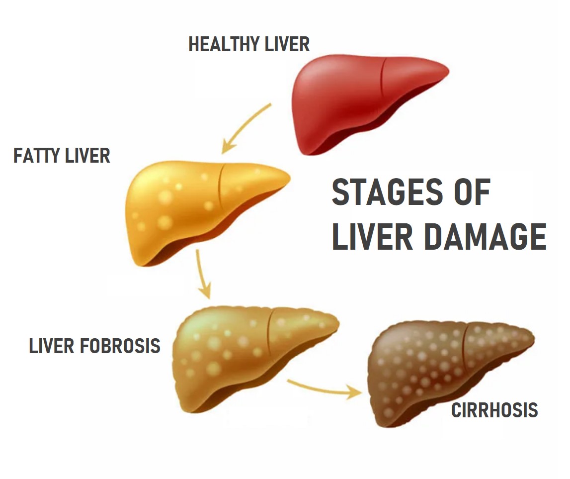 liver_damage_stages