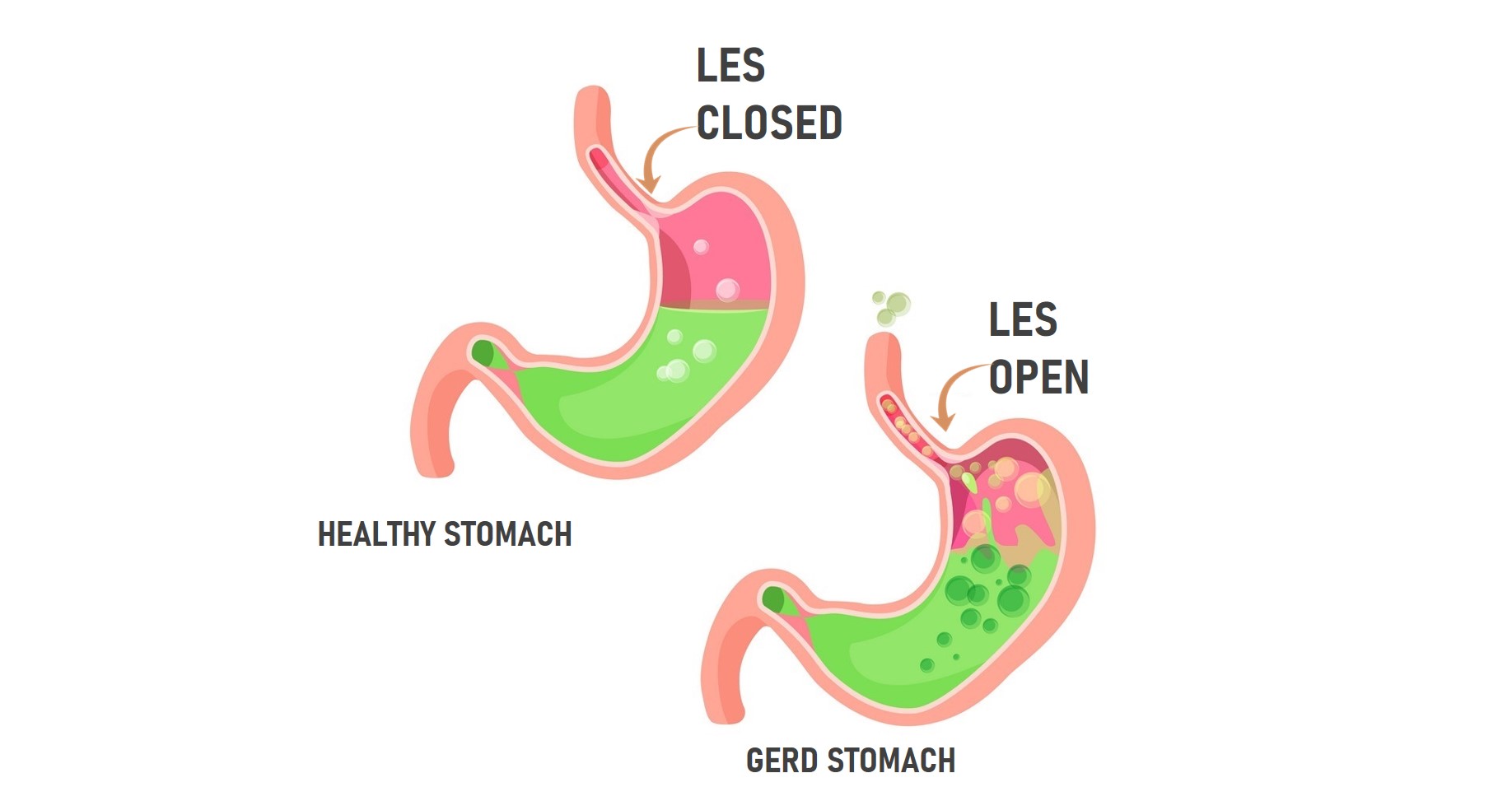 Are You Having Symptoms of GERD? Consult GERD Specialist Before Worsens