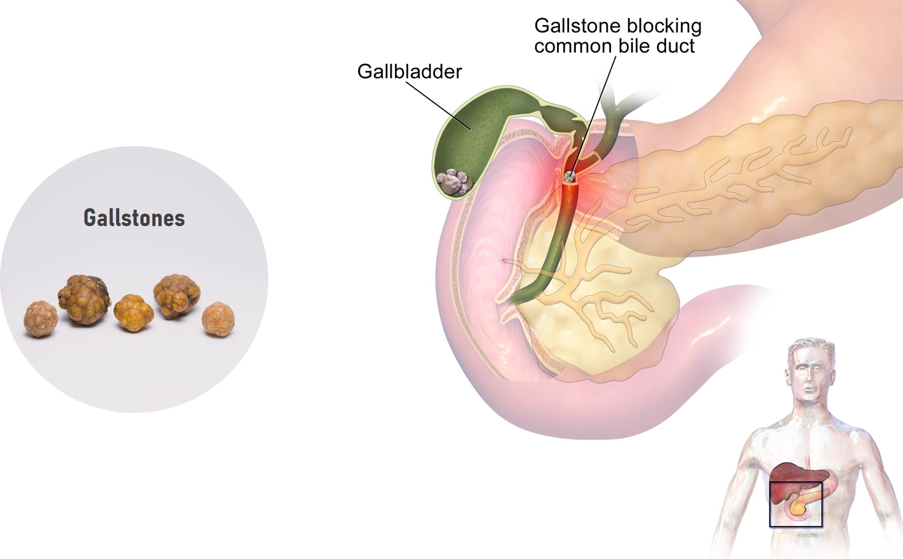 gall bladder stone